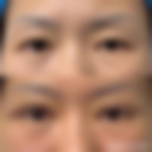 五、双眼皮术后眼皮外翻修复安心吗