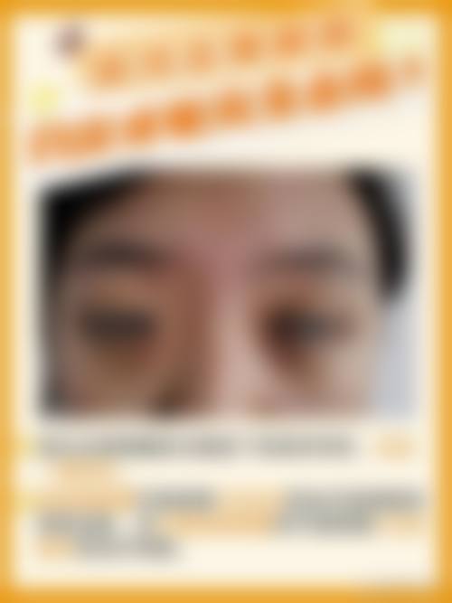 七、黑眼圈和眼袋特别重度怎么办