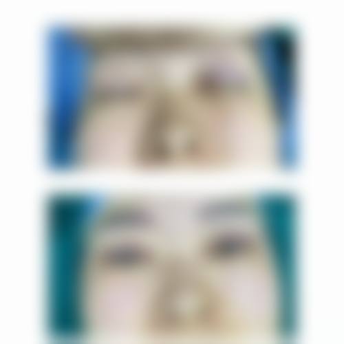 八、黑眼圈和眼袋治疗适合人群判断