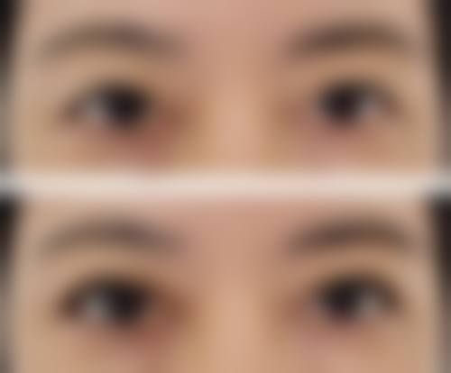 三、眼袋形成的具体原因