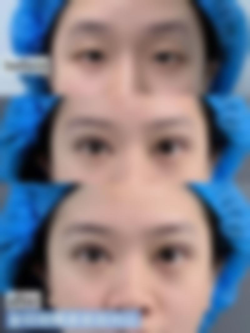 {双眼皮术后眼皮外翻能修复吗？2026水肿外翻消肿可恢复，去皮过量需手术，找【XX医院】咨询（附在线查价） 