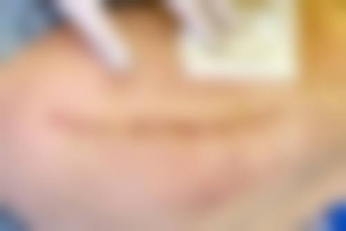 二、激光治疗胸前疤痕疙瘩的成效如何？