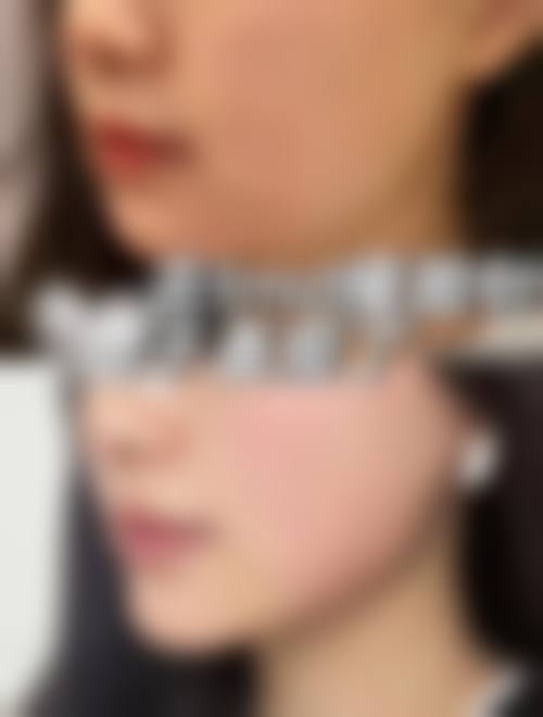 三、瘦腿针和瘦脸针哪个贵