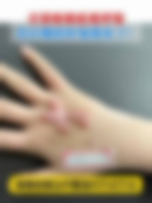 五、艾灸治疗疤痕疙瘩的成效评估