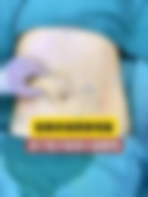 七、怎么判断自己是否适合腹部抽脂