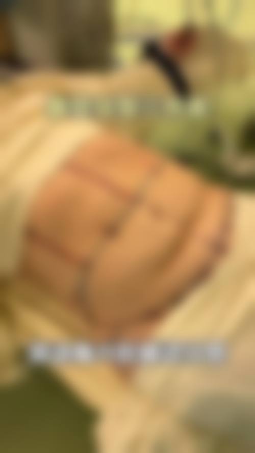 三、腹部抽脂身体多久可以修复