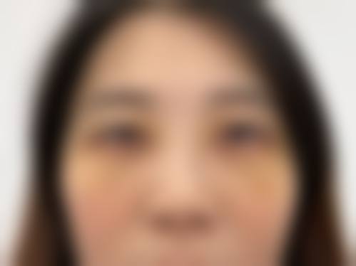 四、手术去眼袋是怎样的体验?