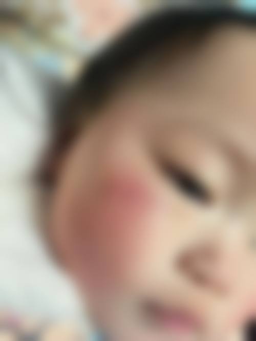 六、预防疤痕增生价格一般多少