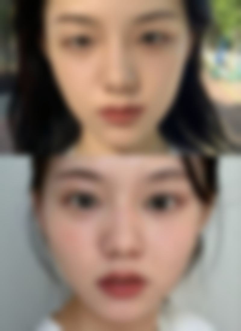 三、3 - 5k全切双眼皮方案避雷指南