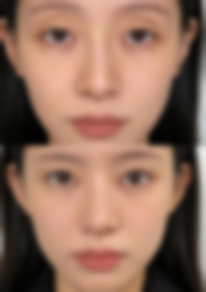 四、全切双眼皮二次修复的风险