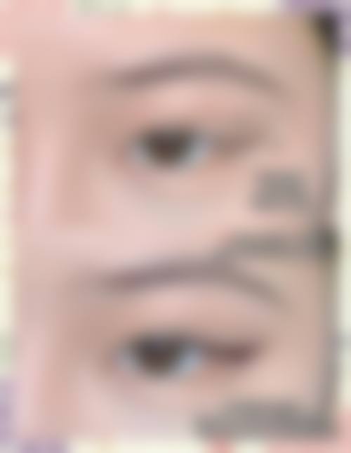 三、省中医双眼皮手术风格有哪些？