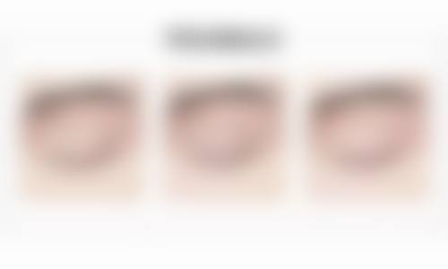 五、眼皮松弛做双眼皮多少钱