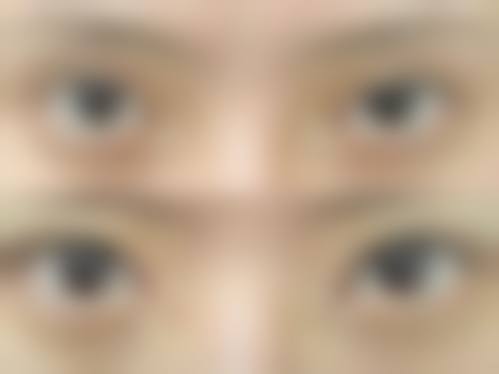 {割双眼皮第五天还是肿正常吗？其实，【美莱医美张医生】实测，割完双眼皮5天还肿很常见！2026年埋线双眼皮￥2000 - 8000，咨询[张医生]领1V1方案 