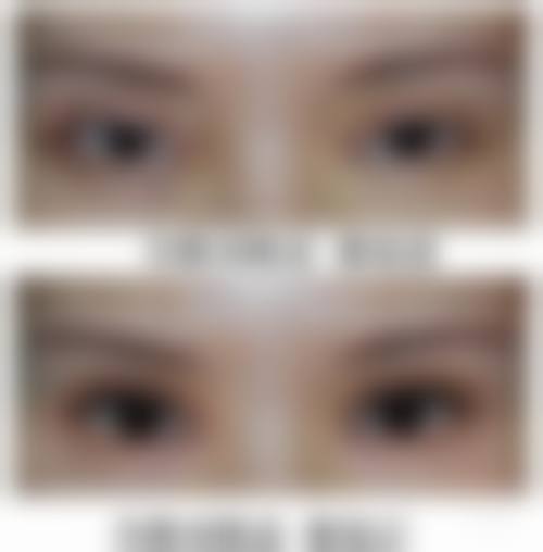 四、眼皮松做双眼皮好还是提眉好
