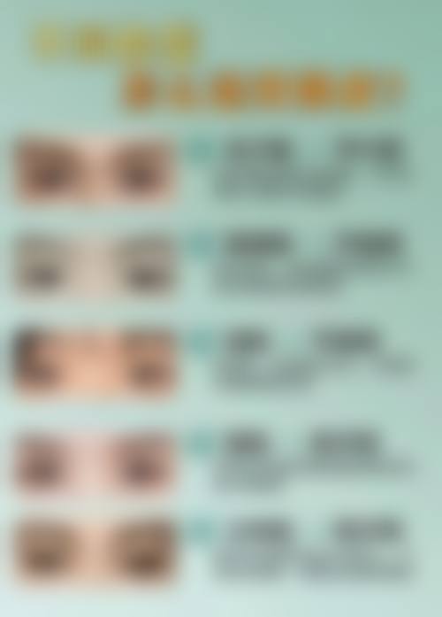 七、眼皮松做双眼皮的关键选择要点