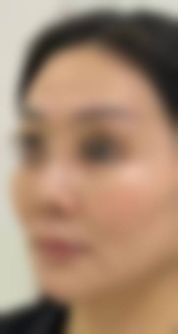 韓國埋線拉提會唔會下垂更嚴重 價錢範圍（HKD/MOP）+ 深圳/珠海對比