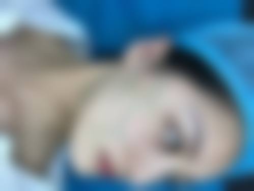 韓國埋線拉提會唔會下垂更嚴重？2026醫生拆解副作用/後遺症+5大避坑指南