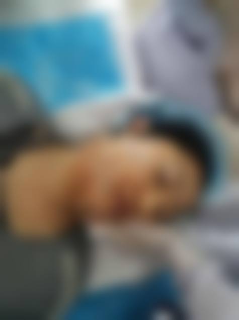 韓國埋線拉提會唔會下垂更嚴重：副作用/後遺症大公開