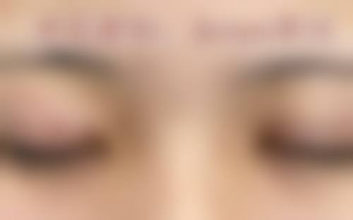 二、眼皮松弛做双眼皮成效好吗