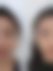 七、割双眼皮第五天又肿又紫怎么办