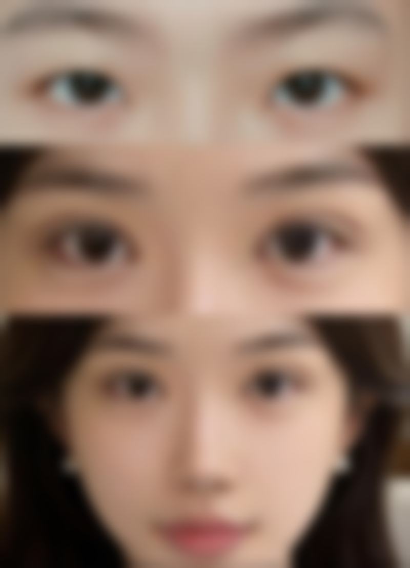 五、割双眼皮术后修复相关问题