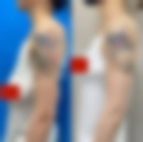 六、肿胀1 - 2周,如何快速消肿让隆胸不被看出?