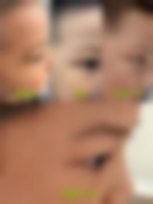 {包皮手术疤痕多久消失？其实3-6个月就能淡化，【同仁医院杨建林主任】实测1年基本无痕，私信领2026疤痕护理方案！