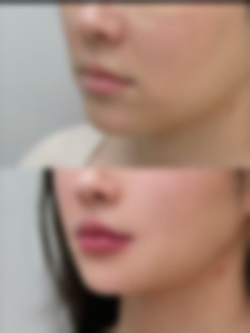 實話實說2026韓國輪廓恢復期真實分享！7日退腫14日消瘀？術後貼士大公開