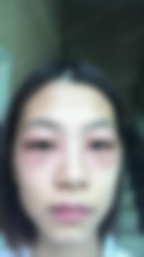 五、询问医生领1V1方案改善宝宝黑眼圈眼袋是怎么回事