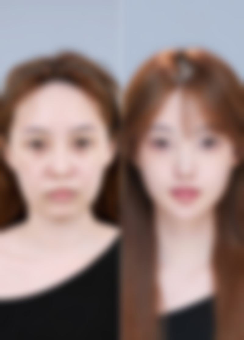 韓國必妩術後管理如何 恢復周期？比港澳本地快幾日？