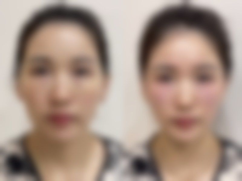 韓國必妩術後管理如何 避坑指南？港澳姊妹必睇