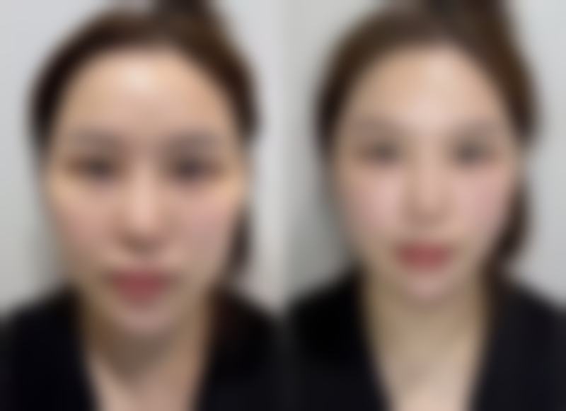 韓國必妩術後管理如何？2026中韓同標準護理流程/收費透明/恢復周期大公開