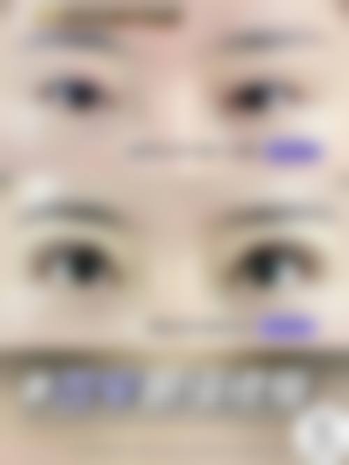 四、双眼皮消肿成效如何