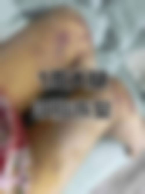 李言医生吸脂项目价格如何?透明合理,性价比高