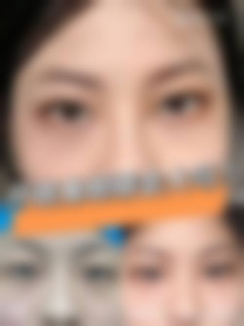 {只有全切双眼皮是永久的吗？2026专家称一般维持5 - 10年，选【北京医院】鲍世威主任定制方案（在线咨询）