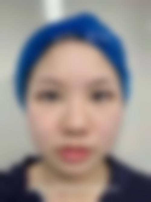 全切双眼皮相关问题解答