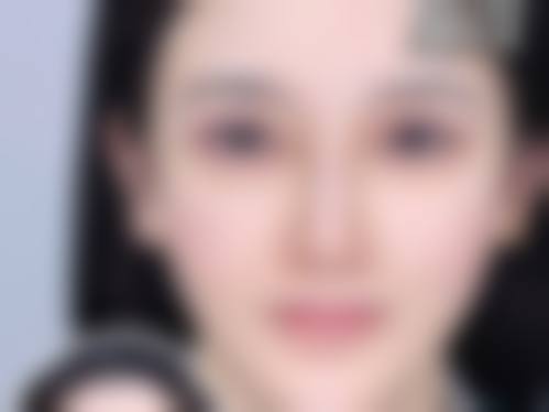 全切双眼皮手术过程揭秘
