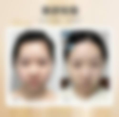 二、瘦脸针产生抗体是怎么回事？