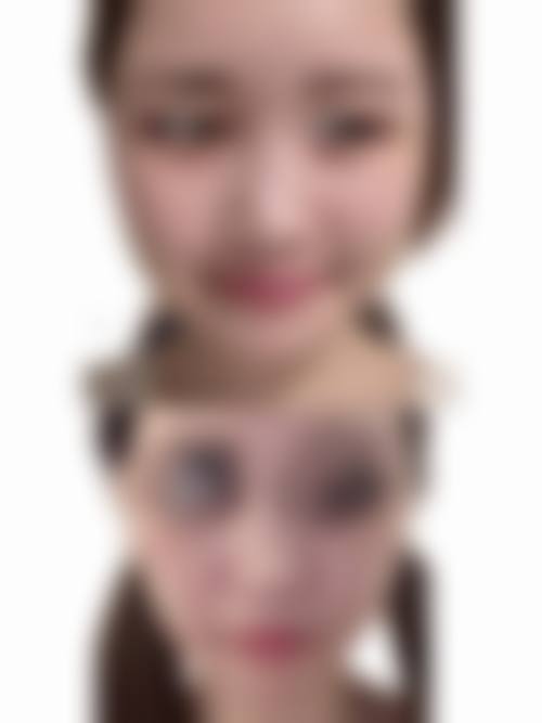 四、瘦脸针产生抗体后还有其他瘦脸方法吗？