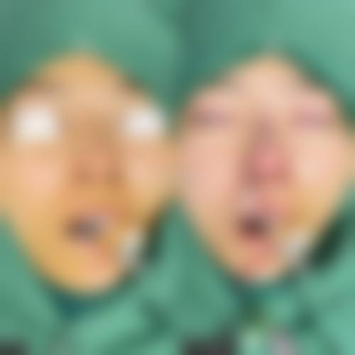四、如何降低隆鼻后遗症致命的风险?
