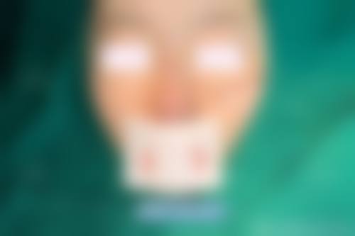 三、隆鼻常见后遗症有哪些?会致命吗?