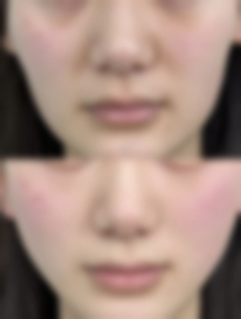 港澳姊妹赴韓整形vs本地/口岸做：邊個更抵？