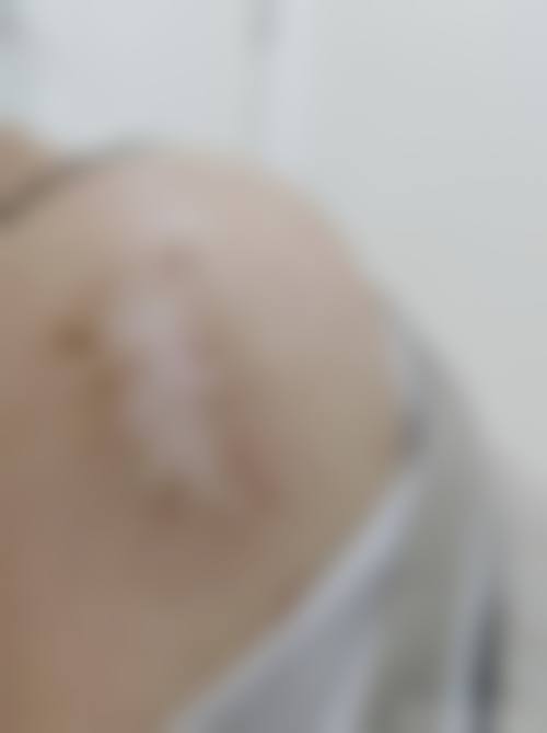五、北京恒丽整形医院真实实例参考