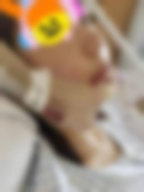 三十多岁地包天能做牙齿矫正吗，有蛀牙怎么办？