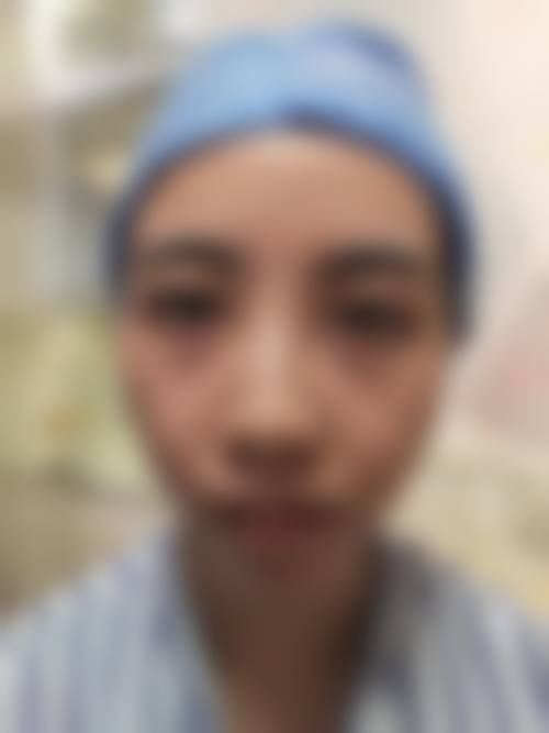 五、外切去眼袋的成效与风险