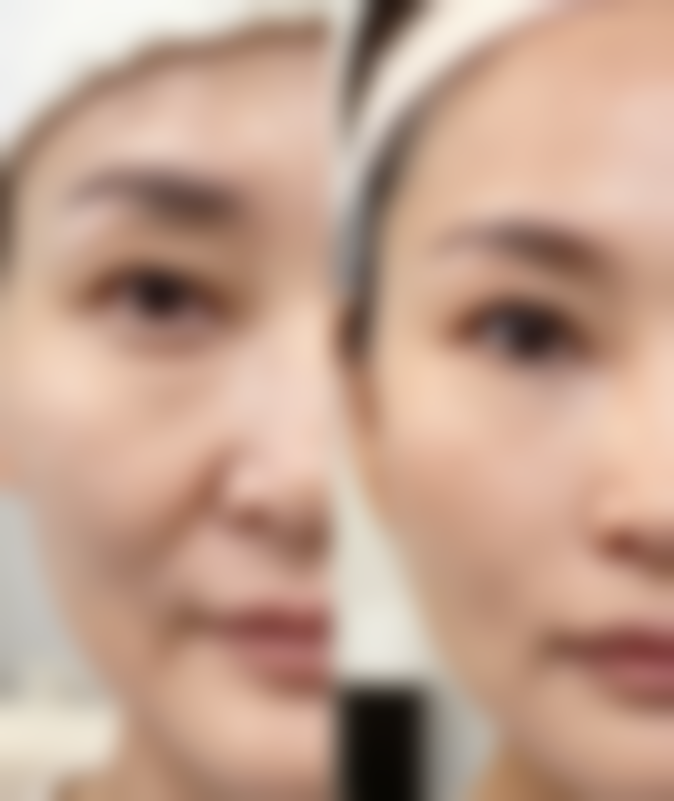韓國TUP皮膚科(T - UPClinic)價格表2026中韓報價:水光針收費邊度更抵?(附深圳实例)