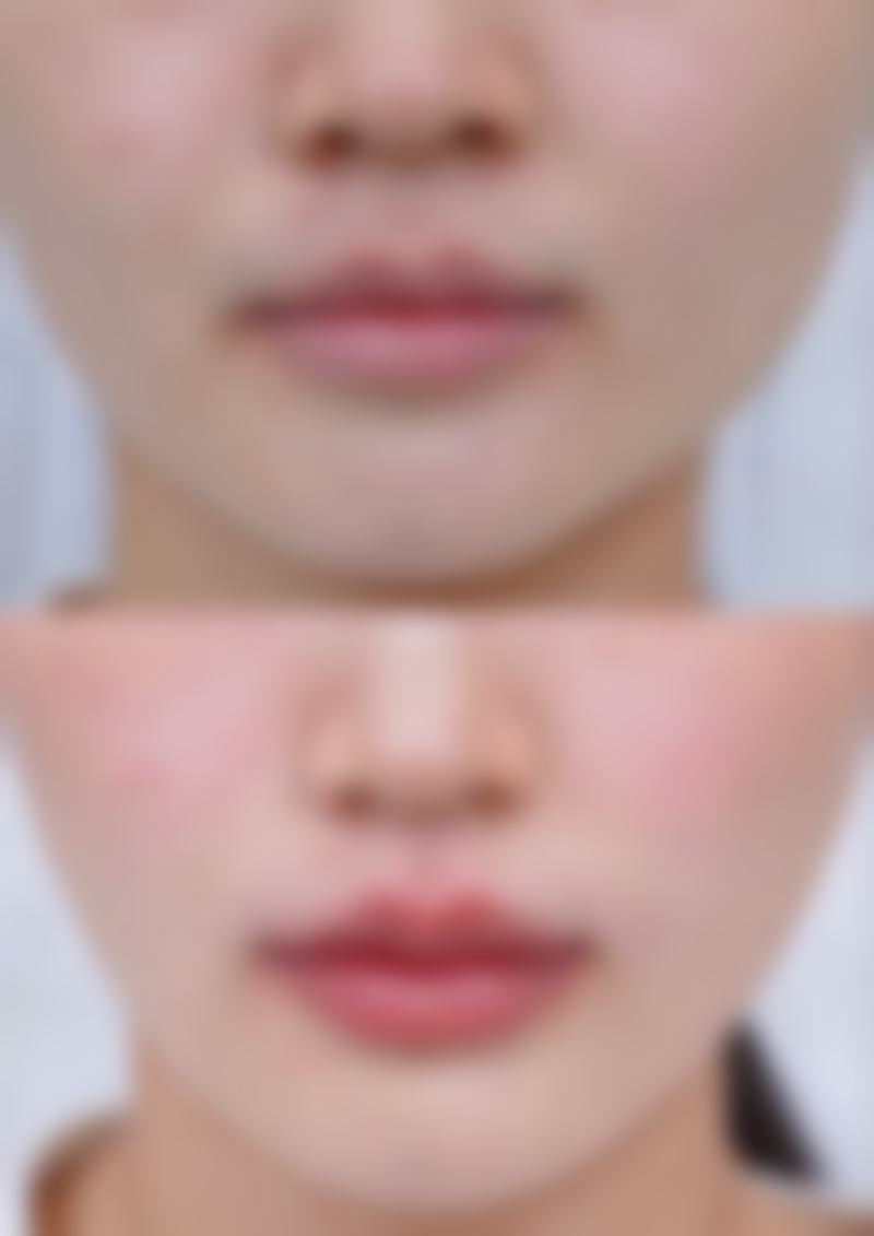 韓國TUP皮膚科(T - UPClinic)價格表2026中韓報價:熱門項目邊樣更受港澳姊妹歡迎?