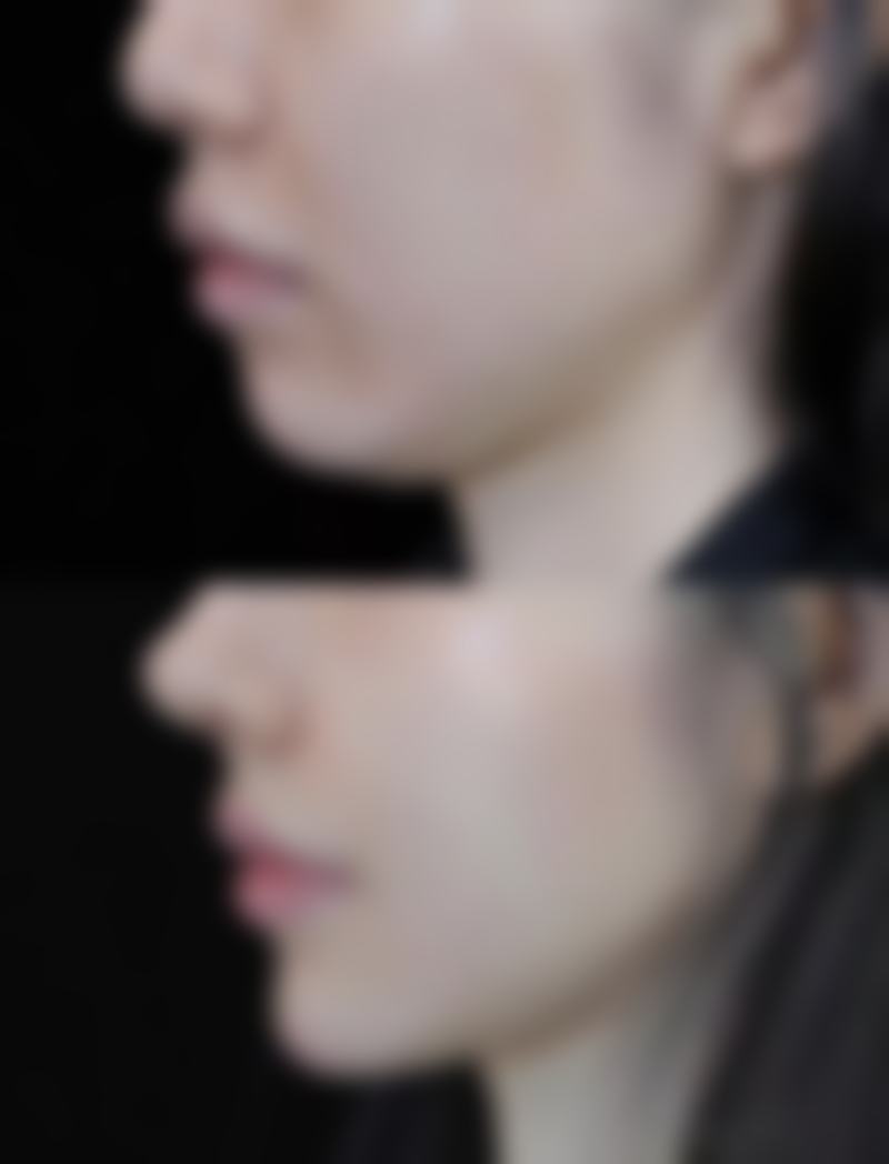 鼻整形項目真相：港澳姊妹常見疑問