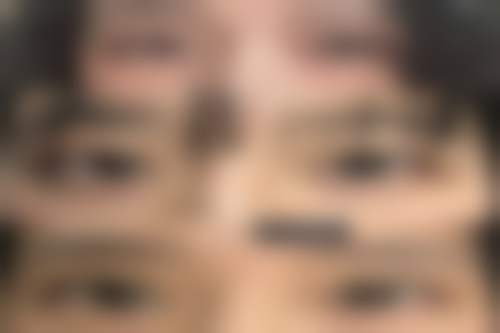 西安熙朵医疗美容门诊部（熙朵植发连锁西安分院）治疗反馈与口碑评价。