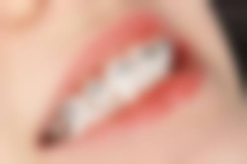 六、老人牙齿矫正如何规避陷阱？